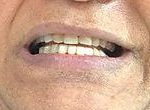 After teeth whitening and Invisalign