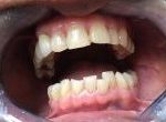 Before teeth whitening and Invisalign