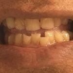 Before Invisalign, porcelain crowns and teeth whitening