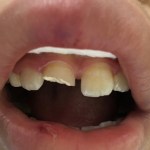 Before dental bonding patient with a tooth split in half