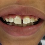 A complete smile after dental bonding