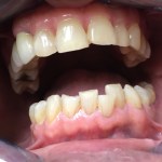 After Invisalign, porcelain crowns and teeth whitening