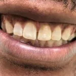 Before one-day porcelain veneers