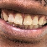 Before one-day porcelain veneers