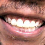 After one-day porcelain veneers