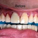Teeth whitening patient before picture