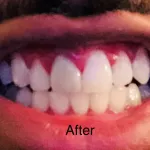 Teeth whitening patient after picture