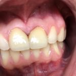 After picture of porcelain veneers on the two front teeth