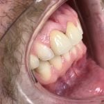 After picture of porcelain veneers on the two front teeth