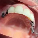Before Dental Implants with the posts visible