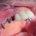 Before Dental Implants with the posts visible