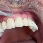 A complete smile after Dental Implants