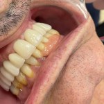 A complete smile after Dental Implants
