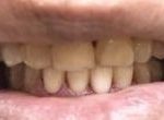 After teeth whitening and Invisalign