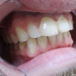 Before picture of porcelain veneers on the two front teeth