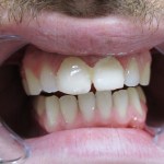 Before picture of porcelain veneers on the two front teeth